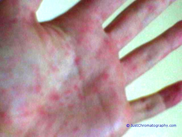 Rash On Palms Of Hands In Children - Doctor ... - HealthTap
